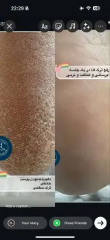 پدیکور کفسابی، درمان ناخن تو گوشت رفته فهیما
