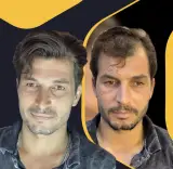 مرکز تخصصی پروتزمو و ترمیم مو(ایران مو) در اصفهان