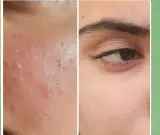 پاکسازی پوست نیلا