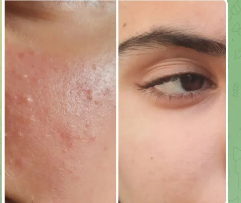 پاکسازی پوست نیلا