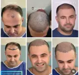 کلینیک تخصصی کاشت مو رشت