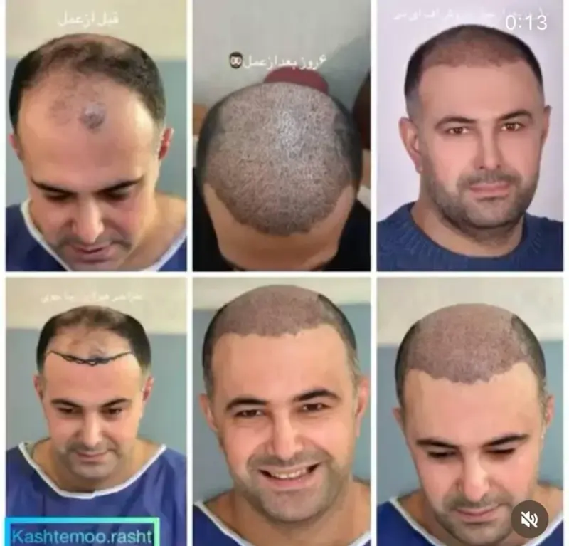 کلینیک تخصصی کاشت مو رشت