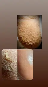 پدیکور درمانی گلی