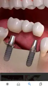 دندانپزشکی ایمپلنت و کلیه خدمات