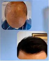 کلینیک کاشت مو منا تصوری