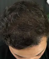 میکرواسکالپ درمان کم پشتی مو حسنی
