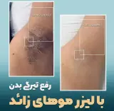 لیزر الماس