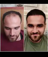 کاشت مو باقریان