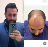 کلینیک کاشت مو گیلان