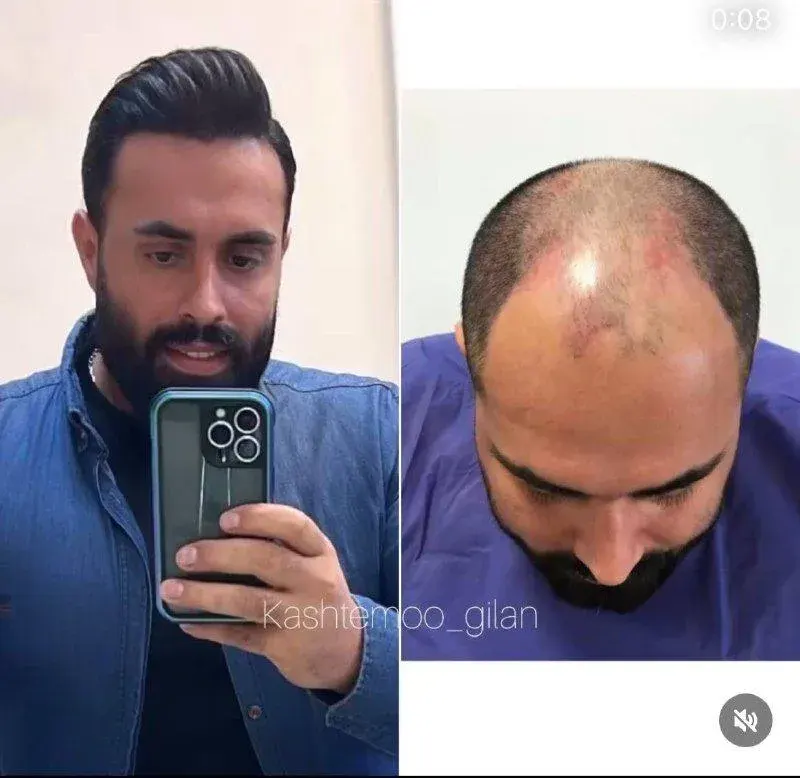 کلینیک کاشت مو گیلان