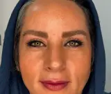 لیزر گلبرگ