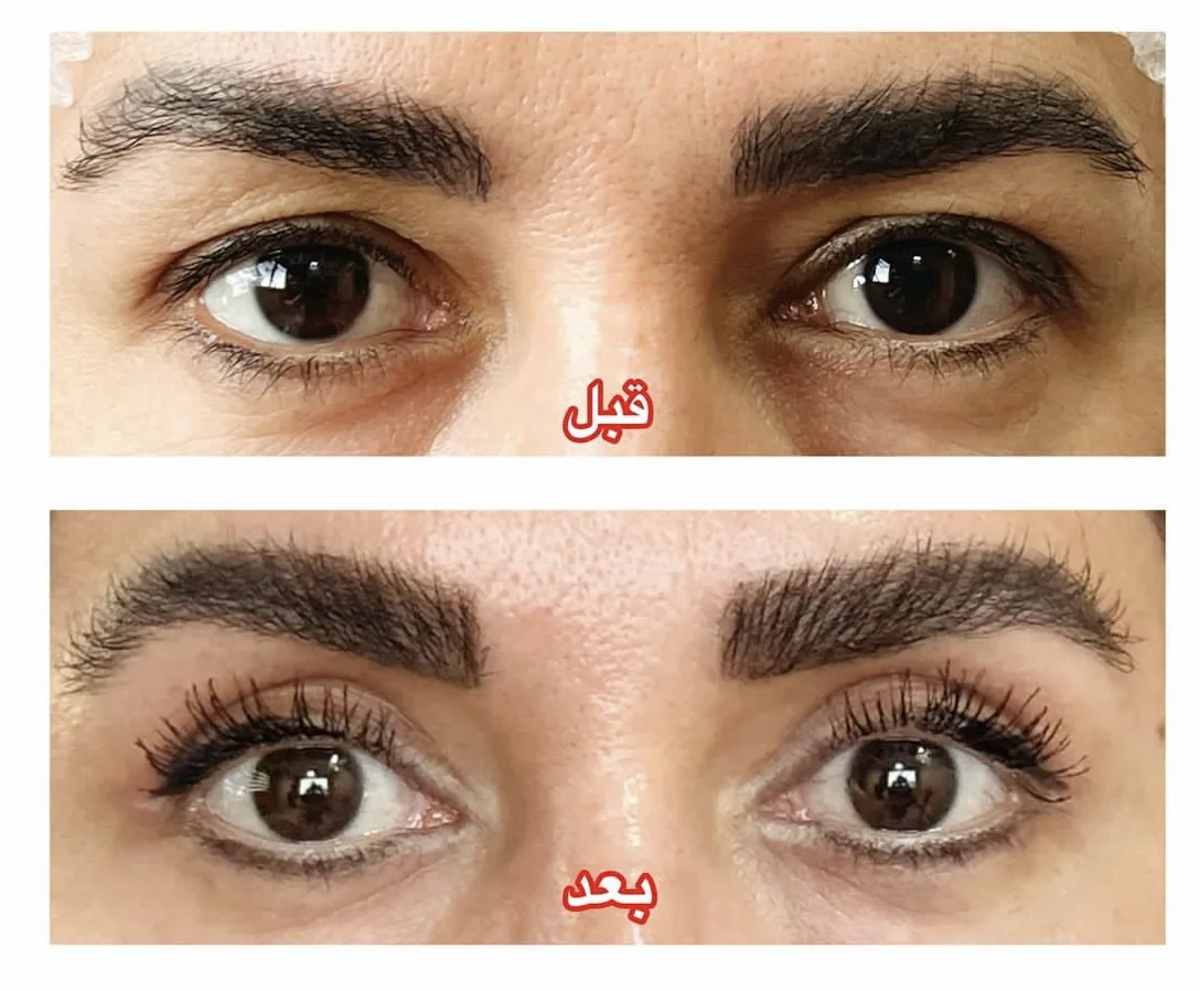 جراحی پلک مشهد_لیزیک مشهد_جراح و متخصص چشم