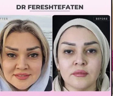 دکتر فرشته فطن/جراح چشم تهران/بلفاروپلاستی/لیزیک