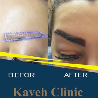 کلینیک کاشت مو وابرو فردیس