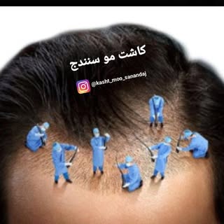 کاشت مو سنندج
