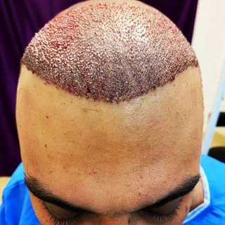کاشت مو/ ابرو /  ریش گرگان گنبد کردکوی بندرگز بهشهر