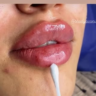 فیلر‌ بوتاکس  ارومیه ژل پوست مو زیبایی مزوتراپی