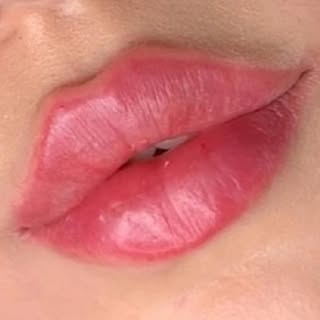 تزریق ژل و بوتاکس - کرج