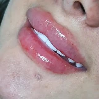کلینیک راد/تزریق ژل بوتاکس چربی/گلشهر