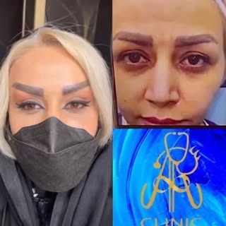 لیفت صورت لیفت ابرو لیفت گونه لیفت شقیقه لیفت گردن