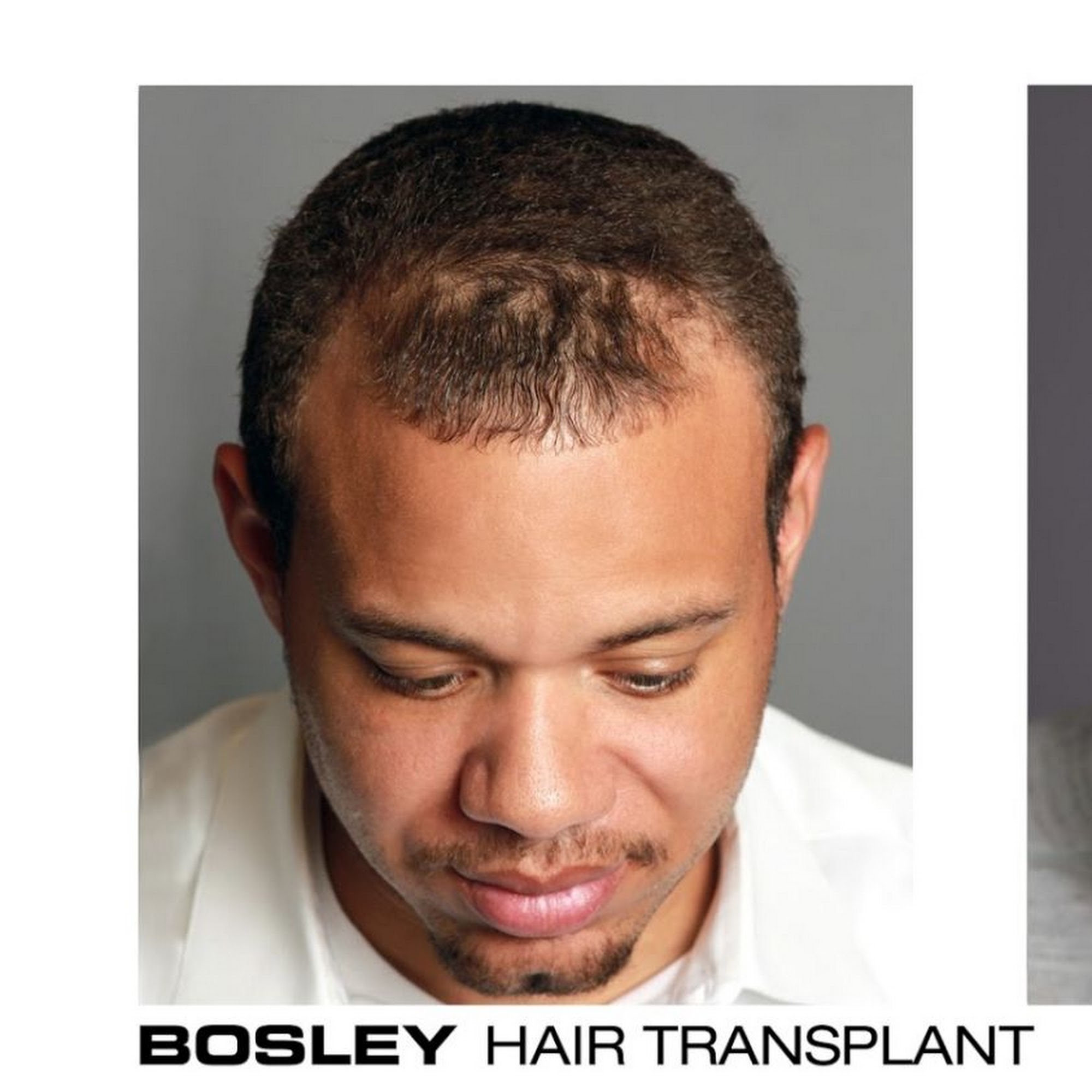 Bosley - Hair Restoration & Transplant - New York