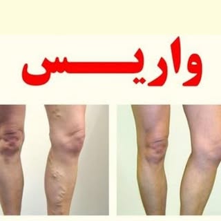 درمان واريس