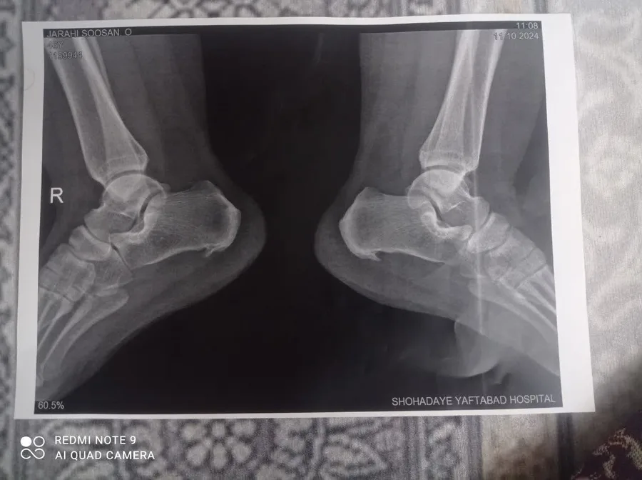 شکسته بندی استاد شهرزاد حکیم