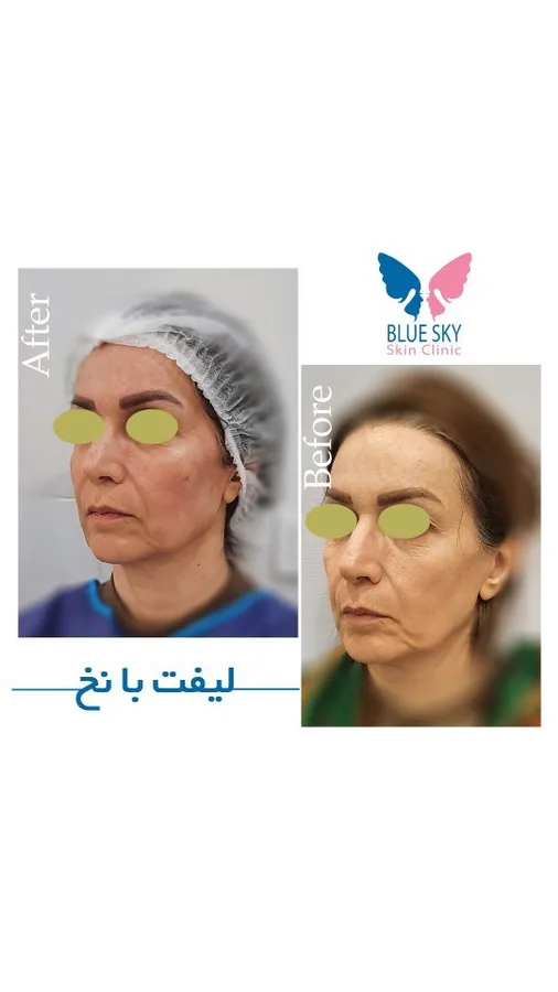 کلینیک آسمان آبى (مرکز کاشت ابرو کرج)