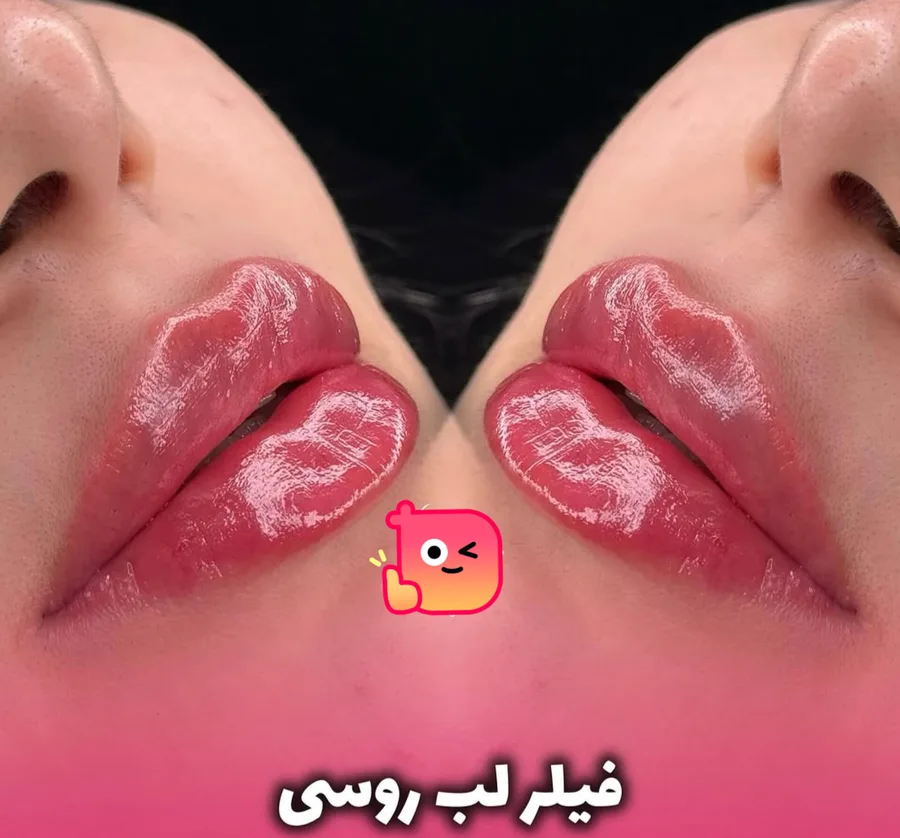 تزریق ژل لب وصورت حرفه ای