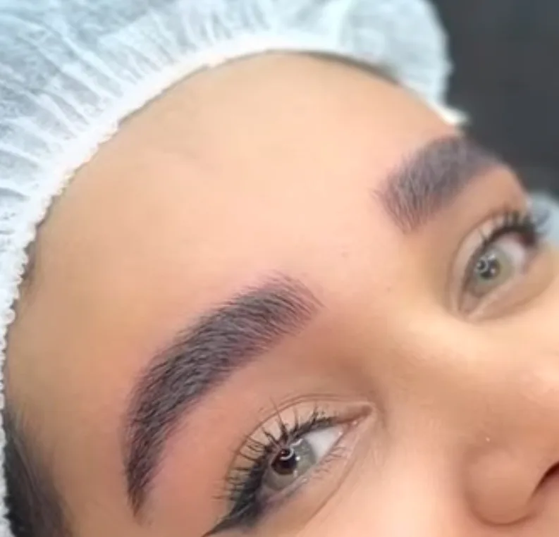 میکروبلیدینگ فیبروزکرمان