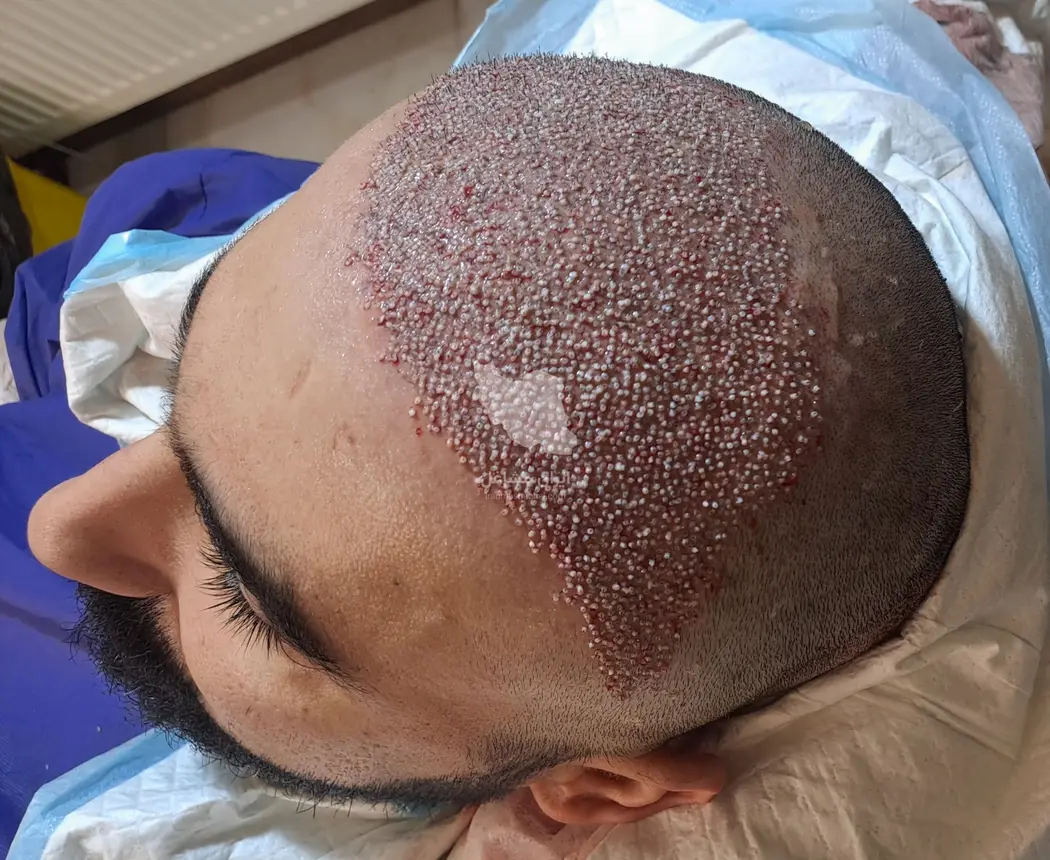 کلینیک کاشت مو تخصصی به صورت اقساطی رضاپور در بابل