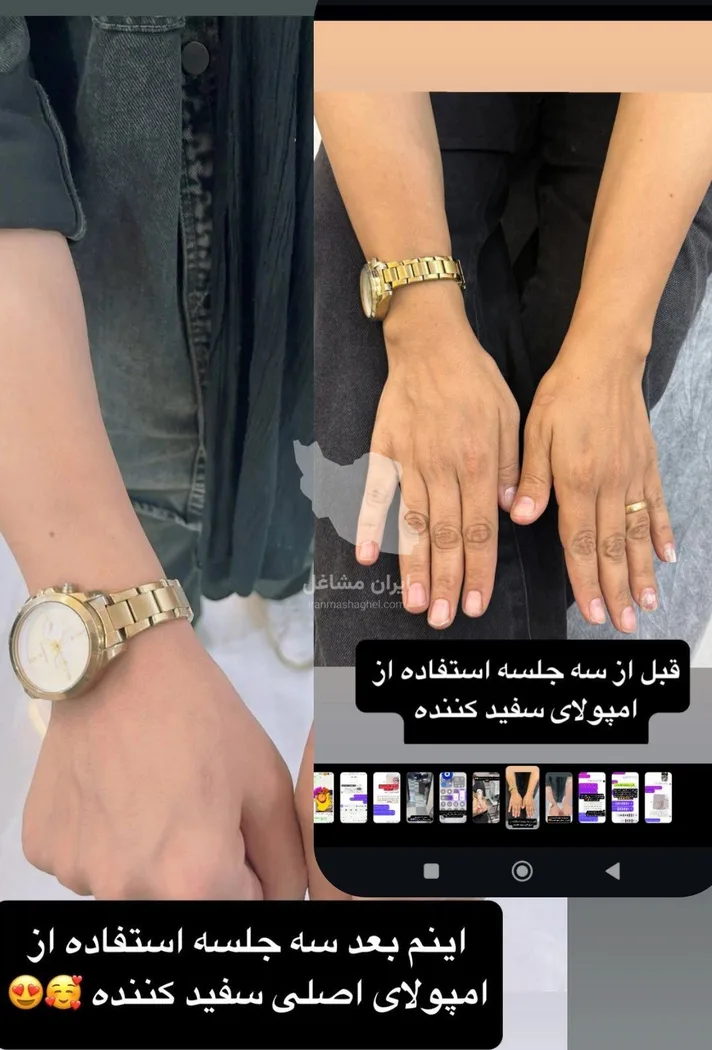 فروش و تزریق سرم سفیدکننده کل بدن لیل در بوکان